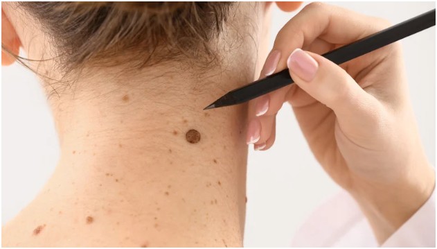 Who Should Get a Skin Check?